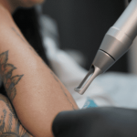 Лазерное удаление тату в Красноярске: профессиональная услуга