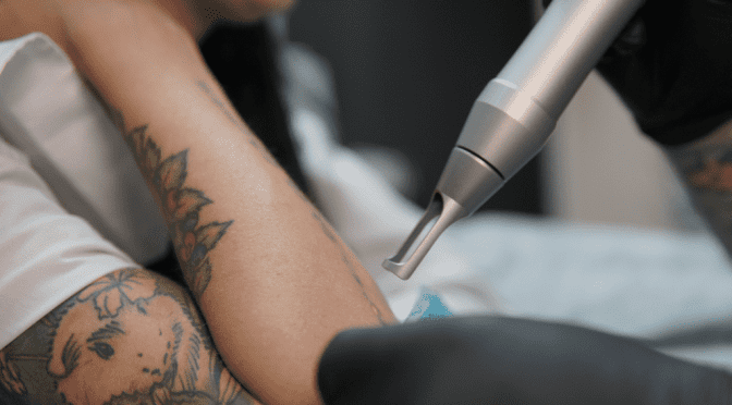 Лазерное удаление тату в Красноярске: профессиональная услуга